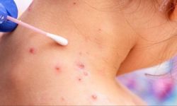 ترقب لإعلان حالة الطوارئ.. "جدري القردة" يثير قلق العالم